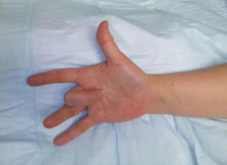 The image displays a person's left hand with the ring finger bent towards the palm, suggesting the condition known as trigger finger.