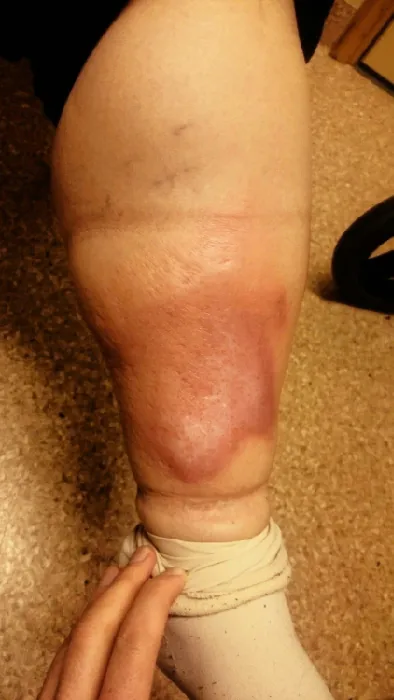 The calf portion of a leg that is swollen.  Near the ankle it is especially swollen, with a discolored, ball shaped protrusion.