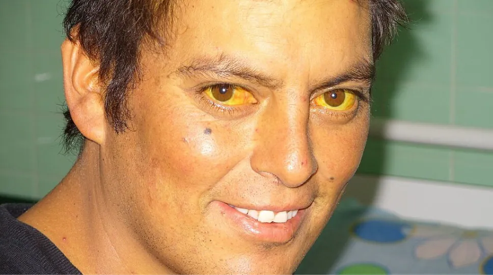 The image shows a man with a noticeable yellowing of the eyes (sclera) and skin, which are classic signs of jaundice. Jaundice is often associated with liver disease or other conditions that affect the processing of bilirubin in the body. The man is smiling and appears to be in a clinical or hospital setting.