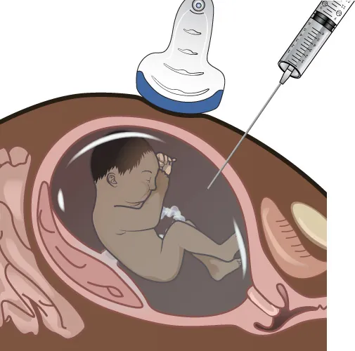 Image of pregnant person with fetus in utero. A large needle is being inserted into the abdomen, going into the uterus and extracting amniotic fluid. Ultrasound wand is visible on abdomen.