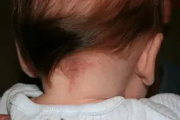 Image of back of infant’s neck displaying red splotches.