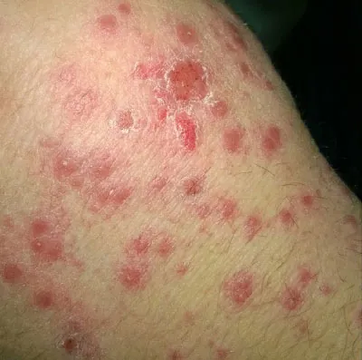 Photo of Guttate psoriasis.