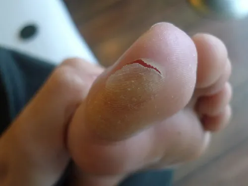 Example of a shear injury – a blister.