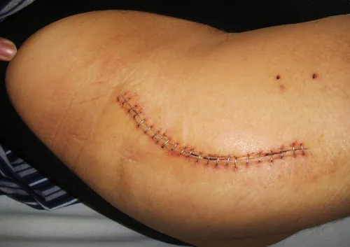 Example of an intentional wound – surgical incision.
