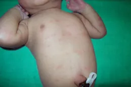 Photo of infant with splotches on torso.