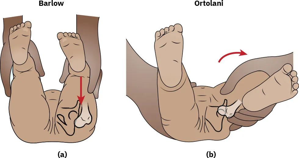 (a) Image of a newborns hips being adducted. (b) Image of a newborn’s hips being abducted.