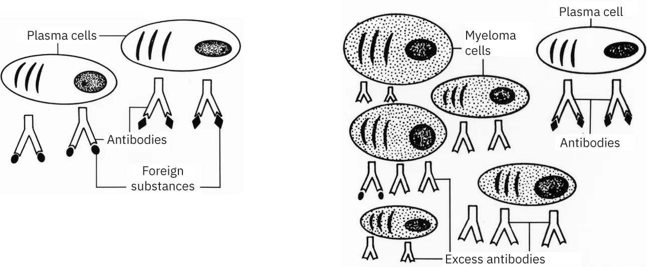 Diagram showing plasma cells, antibodies, and foreign substances; Diagram showing myeloma cells, excess antibodies, plasma cells, and antibodies