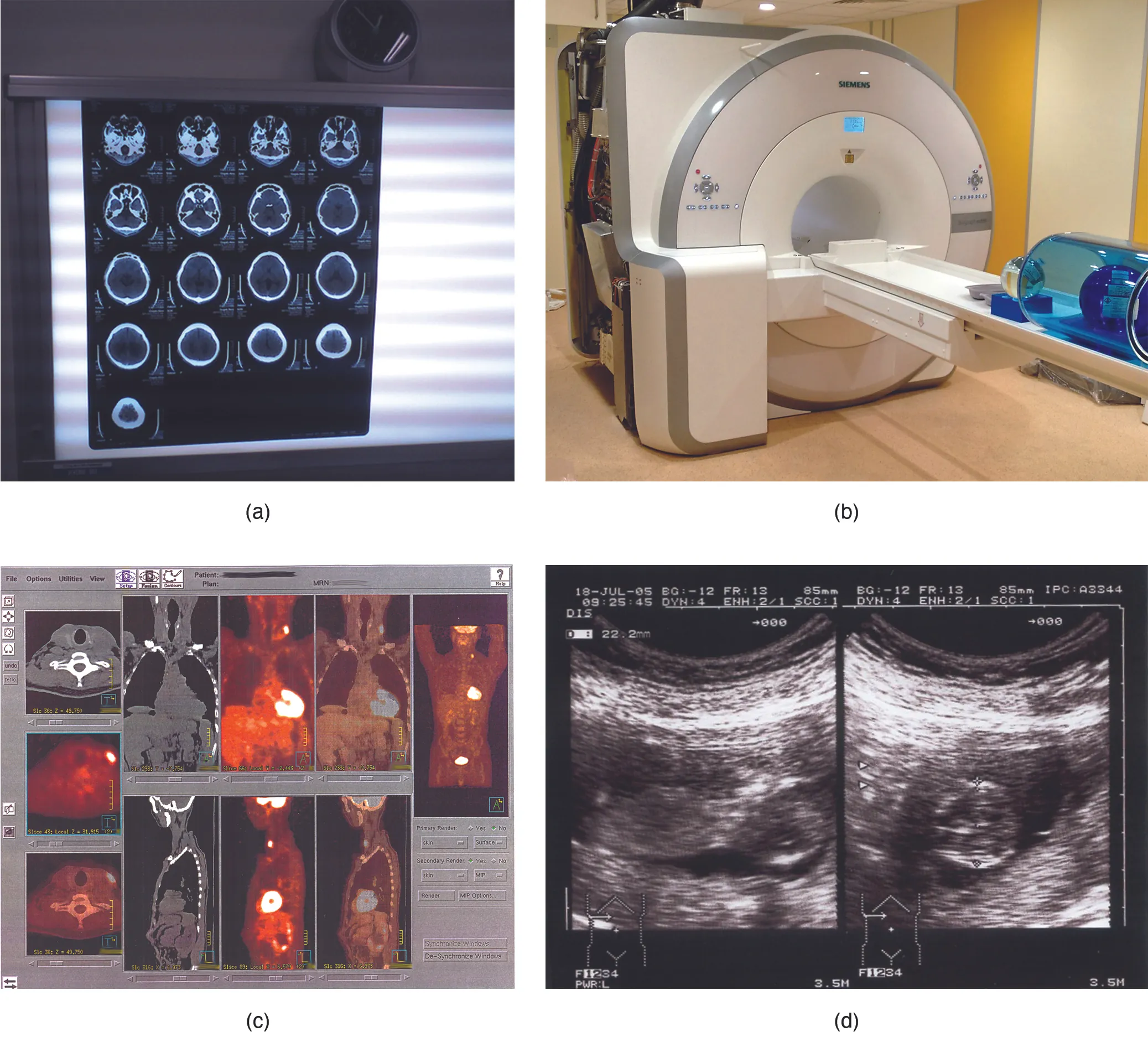 These photos shows four types of imaging equipment. Photo A, the results of a CT scan, shows 17 different transverse views of the skull, each taken at a different depth along the superior-inferior axis. The images are translucent, similar to an X ray, and are viewed on a light board. Photo B shows an MRI machine, which is a large drum into which lying patients enter via a conveyor belt. Photo C shows computer images of the body taken with PET scans. This produces anterior, lateral, posterior, and transverse views of the body that reveal the structure of the internal organs. Photo D shows an ultrasound readout, which is black and white. The image depicts solid tissues as light areas and empty space as dark areas. Some of the features of a young fetus can be seen in the empty space at the center of the image. The space containing the fetus is surrounded by the solid tissue of the uterus.