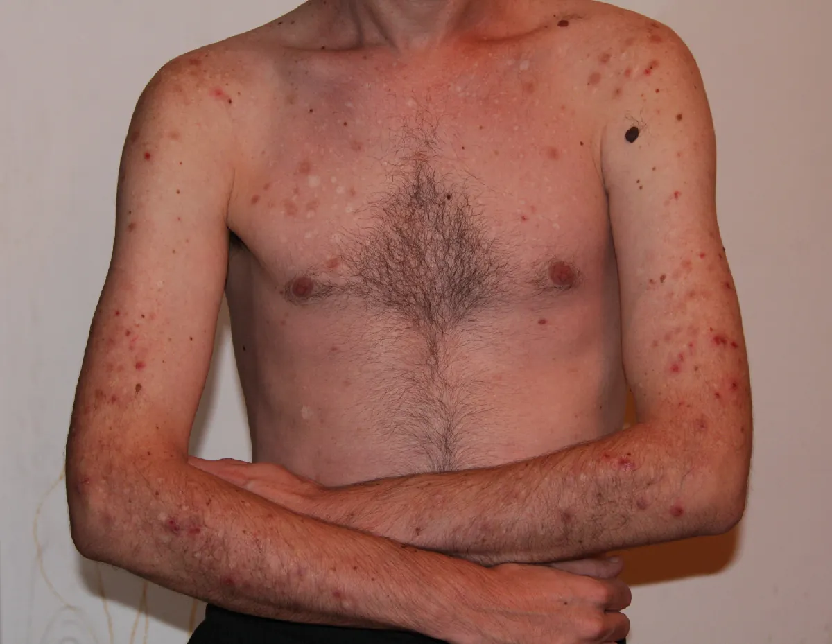 Image of torso with various sized red spots all over.
