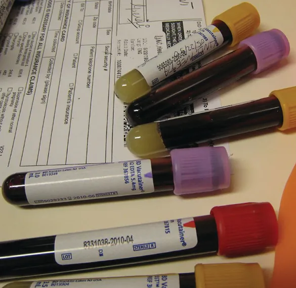 Se muestra una fotografía de 6 viales de sangre que reposan sobre un documento en blanco y negro y cerca de él. Dos de los viales tienen tapones de color púrpura, tres tienen tapones marrón claro y uno tiene un tapón rojo. Cada uno tiene una etiqueta y los viales con tapones marrón claro tienen una pequeña cantidad de un material blanquecino presente en una capa en la base del vial.
