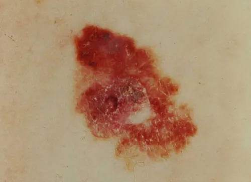 Asymmetric mole