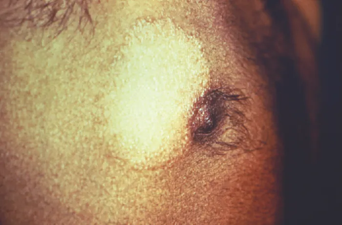 Discolored tissue.