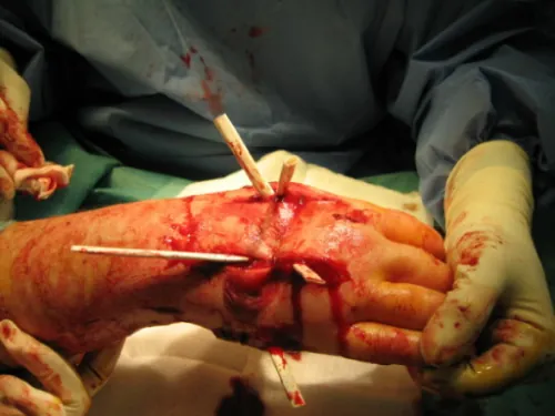 Penrose wound drain