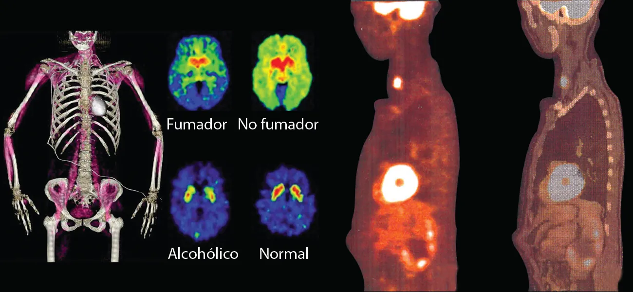 Una imagen muestra cuatro conjuntos de cuadros médicos. La primera corresponde al torso y los brazos de un esqueleto humano con sombreado morado en las regiones musculares. La segunda es un conjunto de cuatro imágenes: la de arriba a la izquierda, marcada como "Fumador", muestra una imagen ovalada que es azul en el borde exterior, verde a medida que se avanza hacia el interior y roja brillante cerca del centro, mientras que la de arriba a la derecha, marcada como "No fumador", muestra una imagen ovalada que está sombreada en verde brillante en su mayor parte y en rojo brillante cerca del centro. La imagen inferior izquierda de las cuatro, marcada como "Alcohólico", es ovalada azul casi en su totalidad con dos pequeños puntos rojos de borde amarillo cerca de la sección superior central. La imagen inferior derecha, marcada como "Normal", tiene un aspecto muy similar a la inferior izquierda, pero las regiones rojas son un poco más grandes. La última imagen muestra dos exploraciones de un torso humano de lado. La exploración de la izquierda tiene tres zonas blanco-amarillentas brillantes: una en la garganta, otra en el pecho y otra en la cabeza. La exploración de la derecha es igual que la de la izquierda, salvo que las regiones brillantes son más tenues y los órganos internos están más definidos.